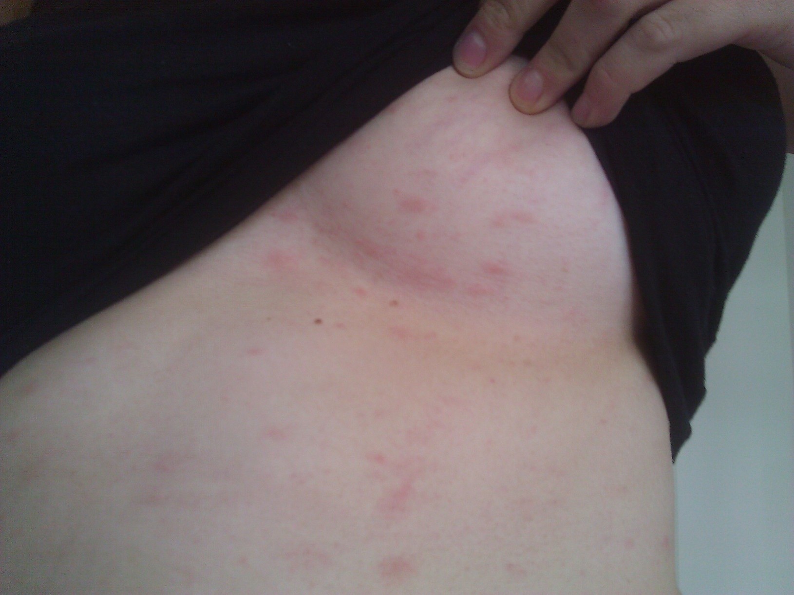 Nicht juckender Ausschlag Brust/Bauch (Haut, Allergie, Insektenstich) Nicht juckender Ausschlag Brust/Bauch (Haut, Allergie, Insektenstich)