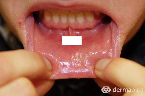 Normal Dass Lippe Innen Uneben Ist Mundschleimhaut Normal Dass Lippe Innen Uneben Ist Mundschleimhaut
