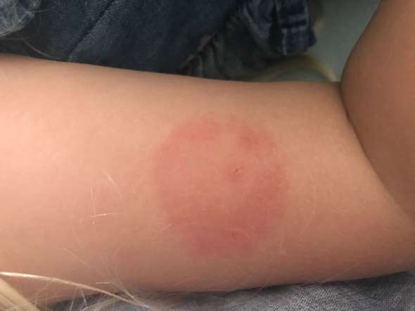 Normaler Muckenstich Haut Entzundung Allergie Normaler Muckenstich Haut Entzundung Allergie