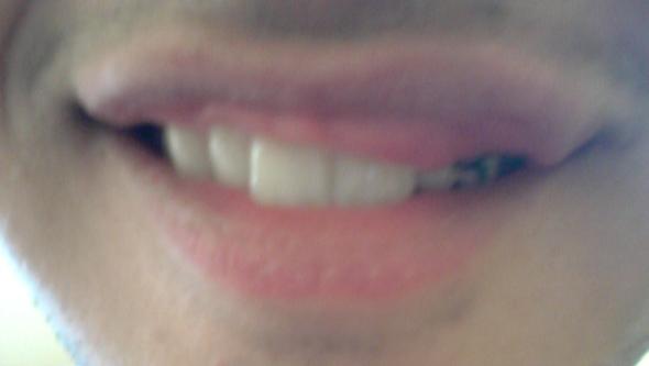 Get Pickel An Der Lippe Geschwollen PNG