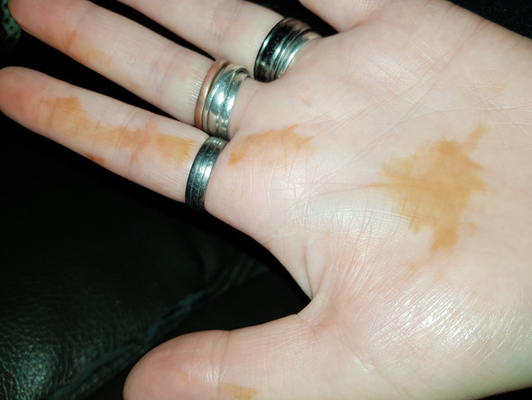 - (Flecken, Handinnenfläche)