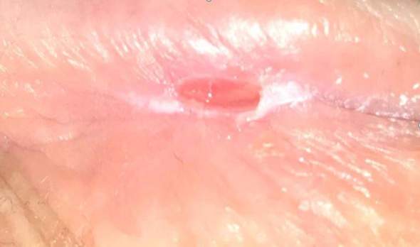 Auf rote eichel salbe welche der flecken Eichelentzündung: Jucken