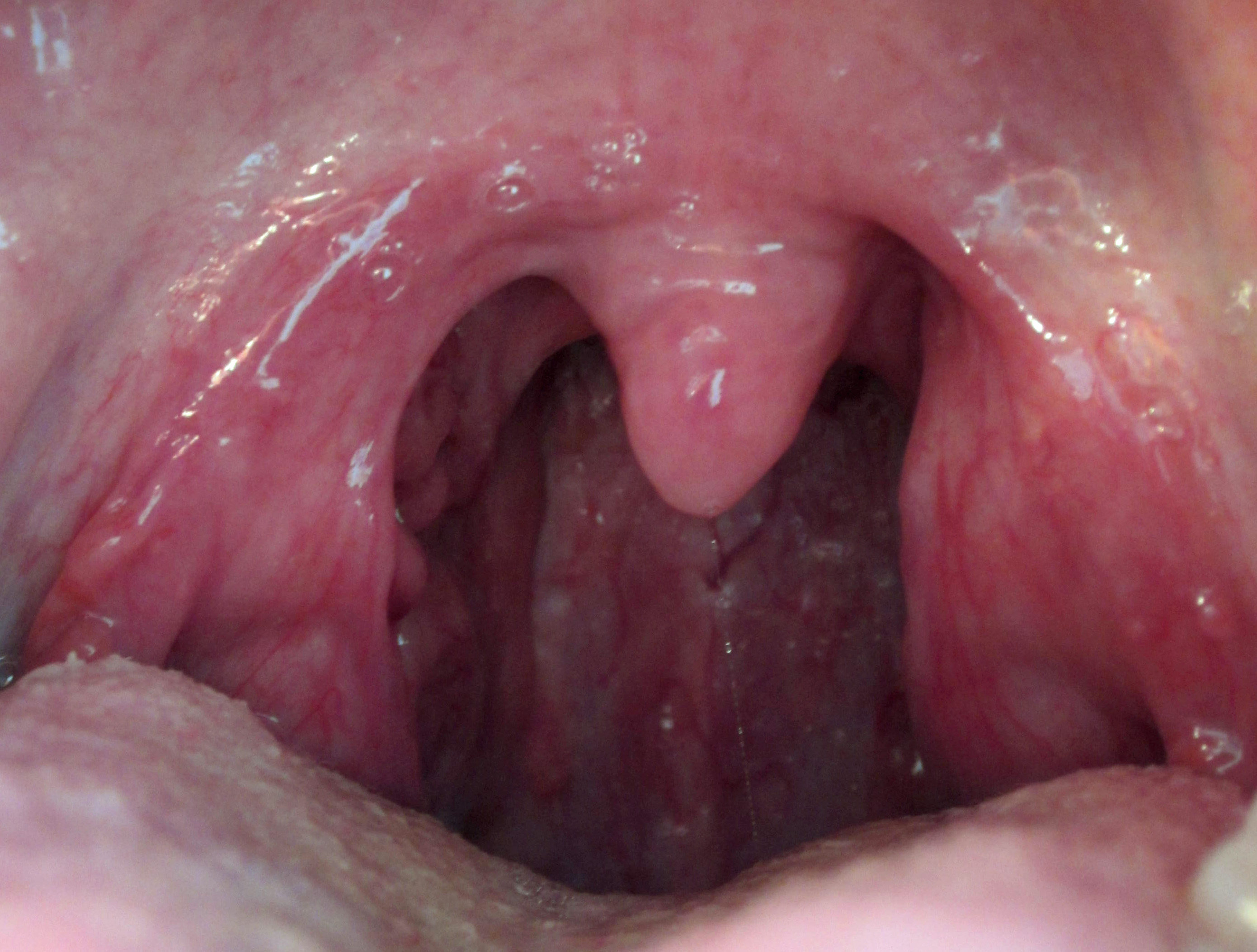 Permanente Halsschmerzen, Infektion der Atemwege, Mandelentzündung oder Permanente Halsschmerzen, Infektion der Atemwege, Mandelentzündung oder