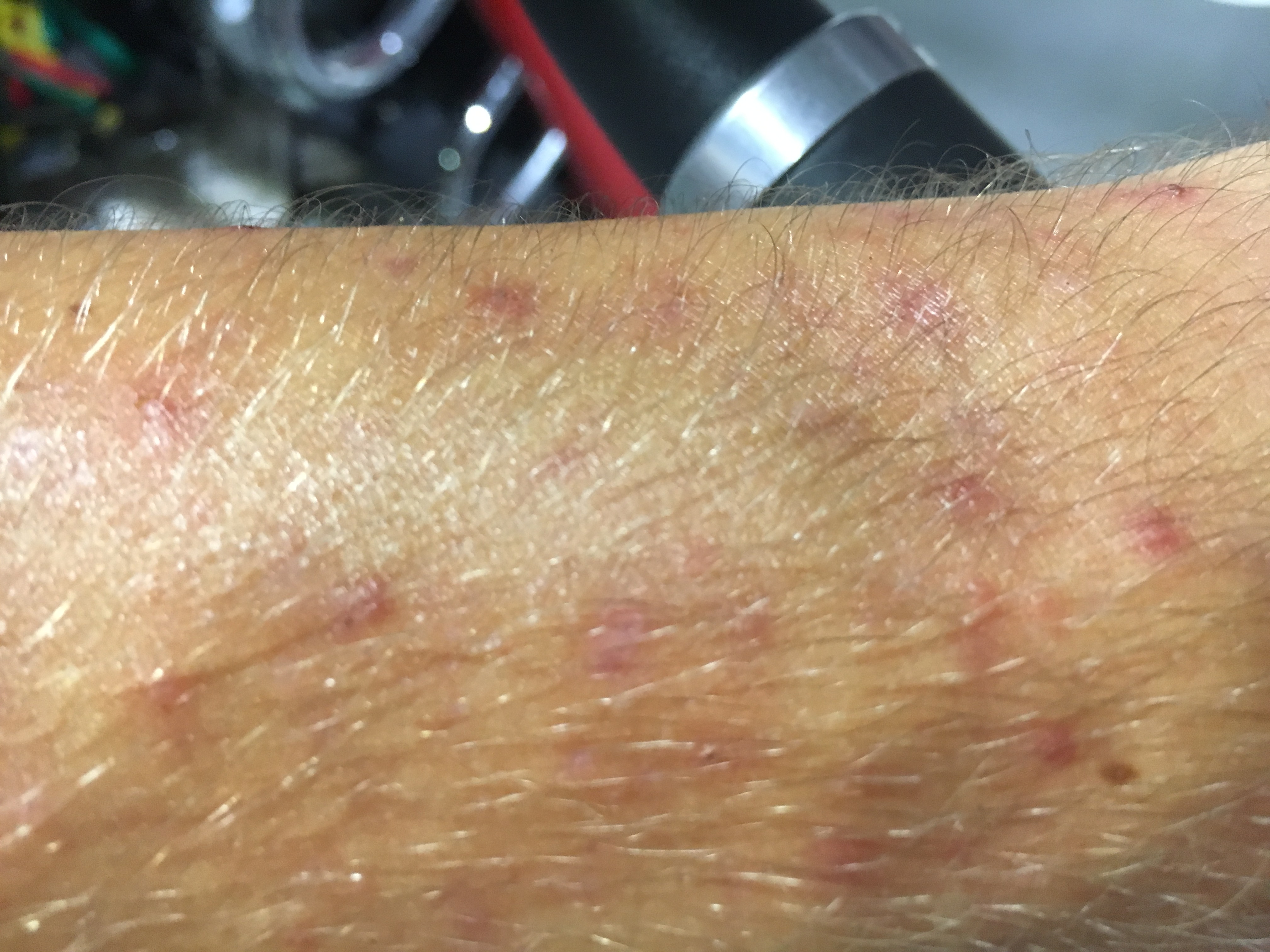 pickel auf dem arm pickel auf dem arm