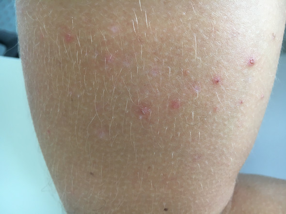 pickel arme pickel arme