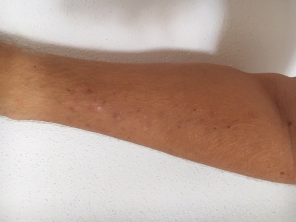 Pickel / Rötungen an den Armen? (Arm, Akne) pickel an der schulter
