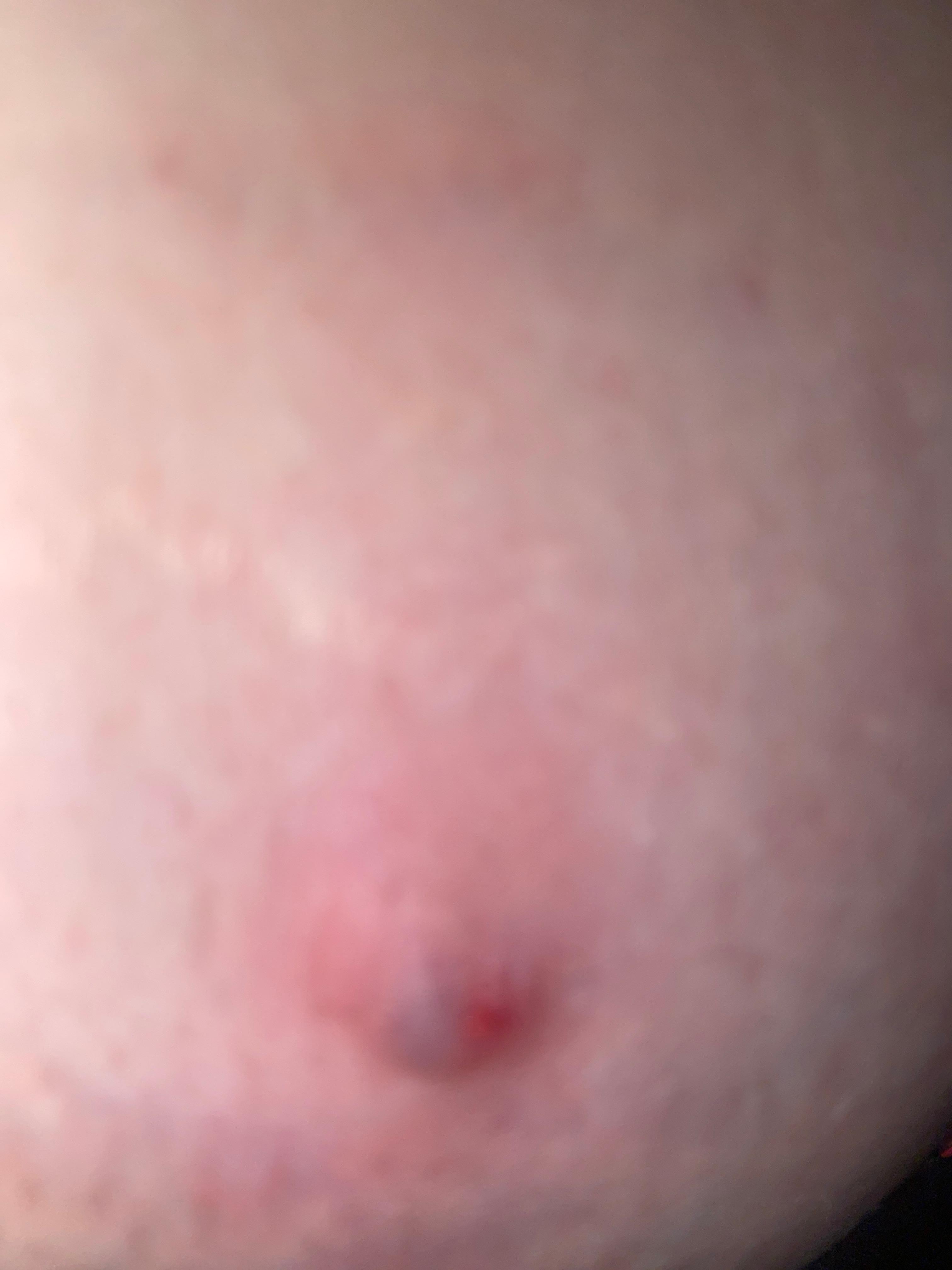 Pickel? (Haut, Entzündung) Pickel? (Haut, Entzündung)