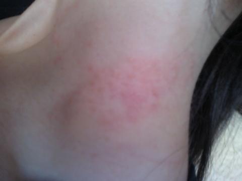 Pickel Am Hals Haut Juckreiz Pickel Am Hals Haut Juckreiz