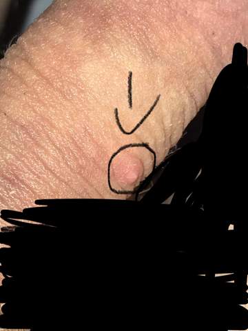 Pickel Am Penis Ist Das Eine Zyste Manner Pickel Am Penis Ist Das Eine Zyste Manner