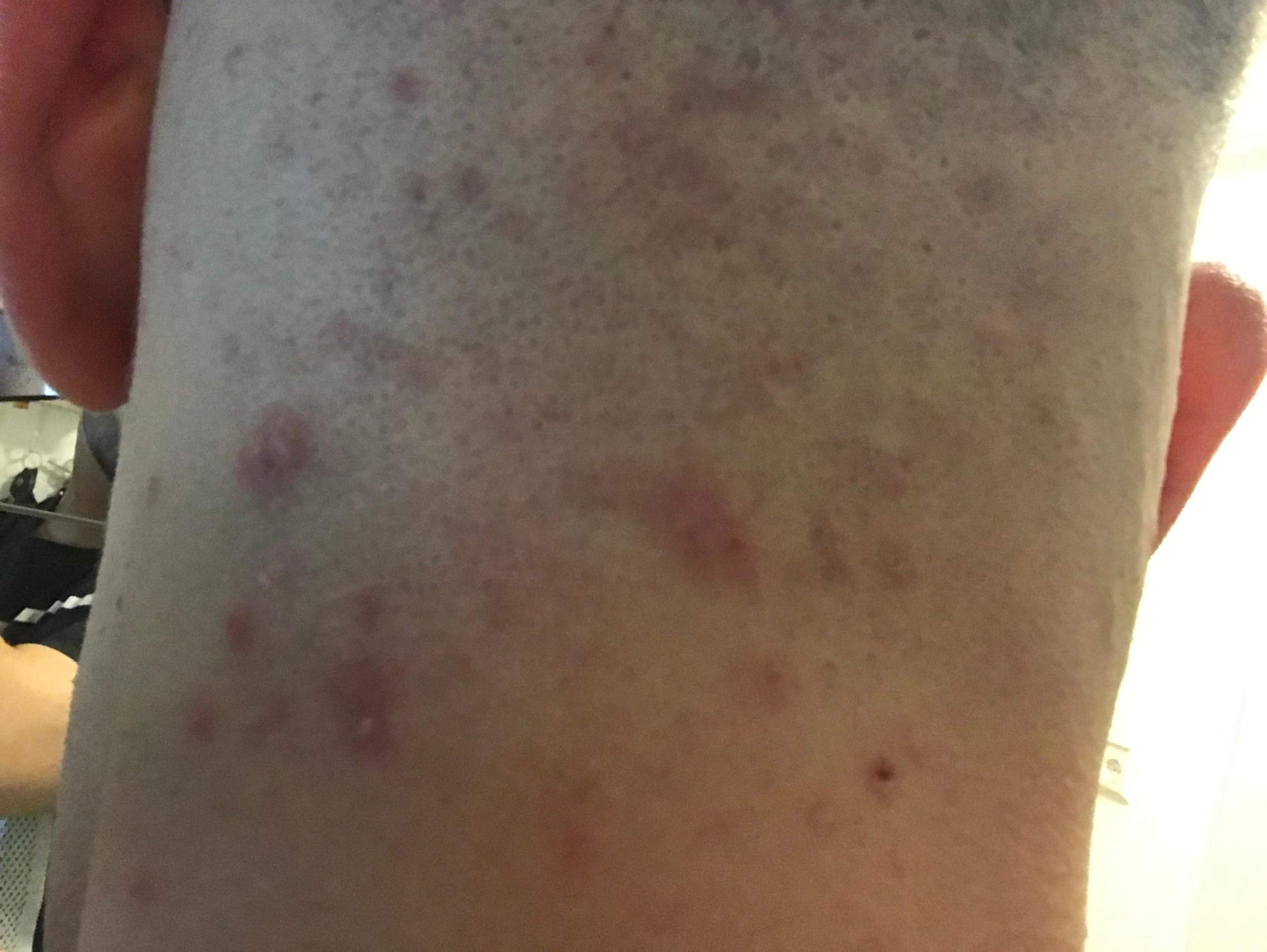 Pickel auf der Kopfhaut/Nackenbereich? pickel auf der kopfhaut