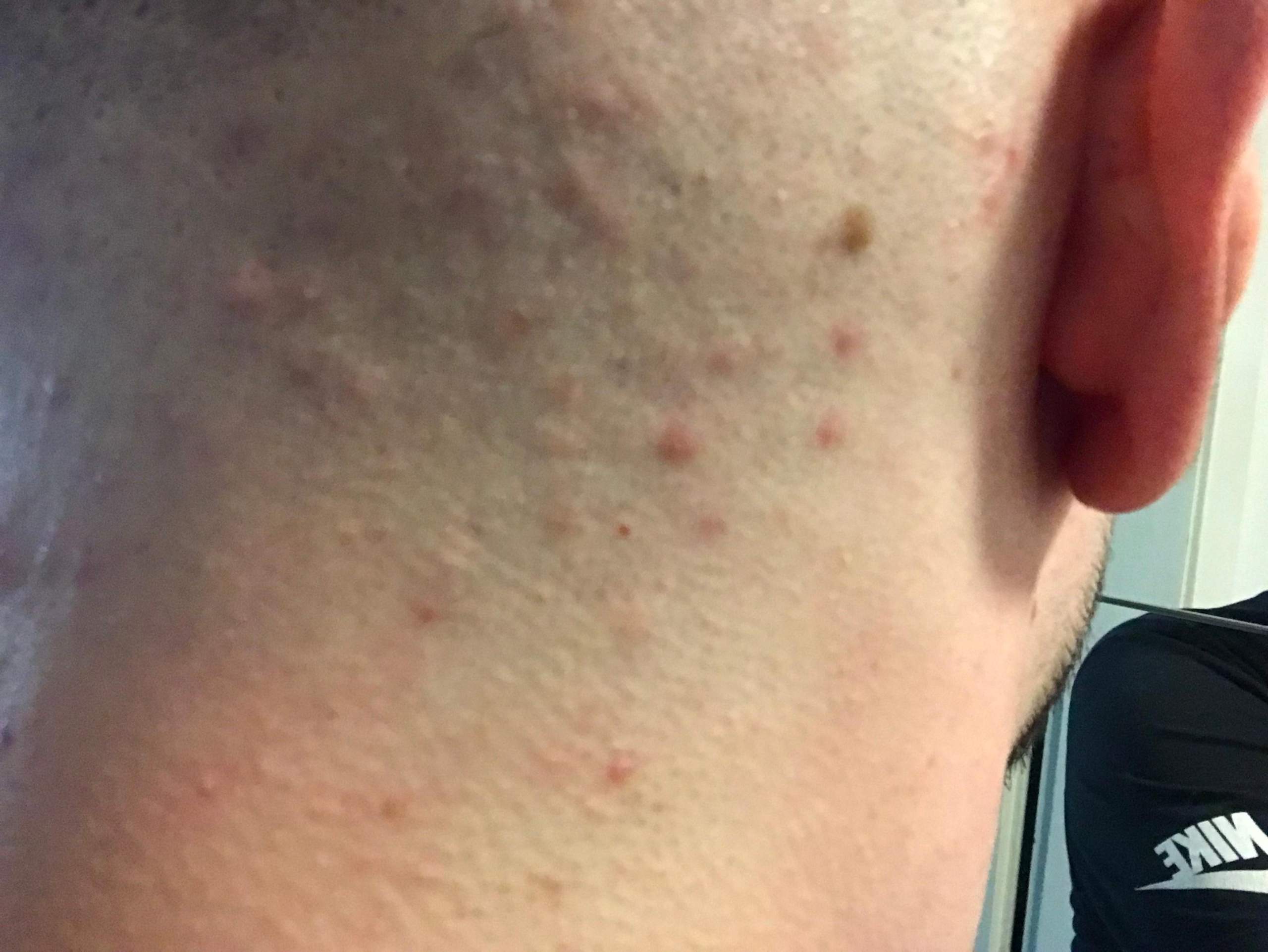 Pickel auf der Kopfhaut/Nackenbereich?