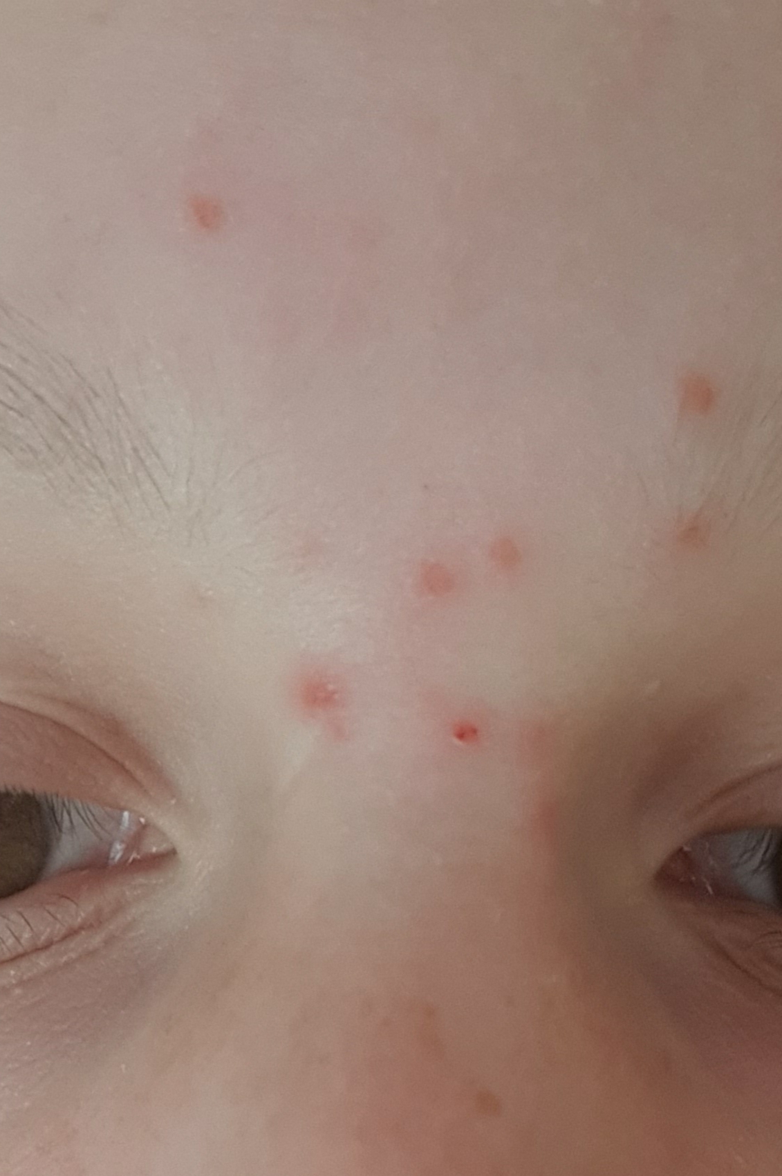 pickel bei erkältung pickel bei erkältung