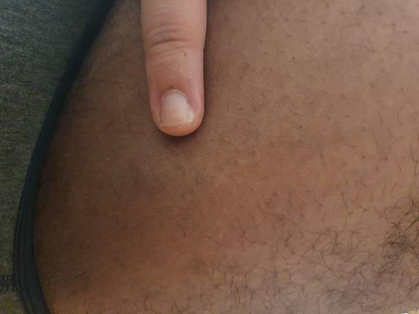 - (Schmerzen, Haut, Pickel)