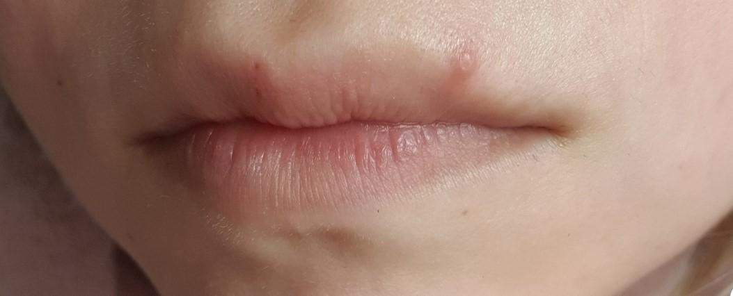 Pickel oder Warze an der Lippe? (Haut, Warzen, Herpes)