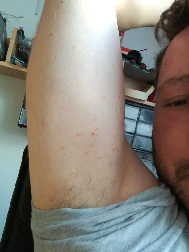 Pickel und Pusteln auf der Haut? Was ist das? Krätze? (Dermatologie)