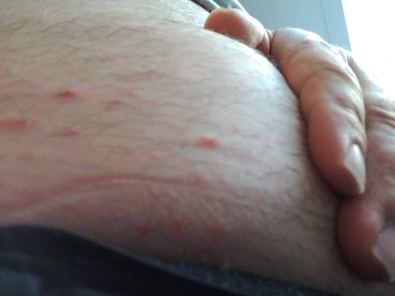 Pickel und Pusteln auf der Haut? Was ist das? Krätze? (Dermatologie)