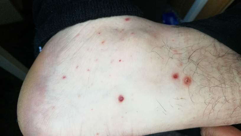 Pickel und Pusteln auf der Haut? Was ist das? Krätze? (Dermatologie)