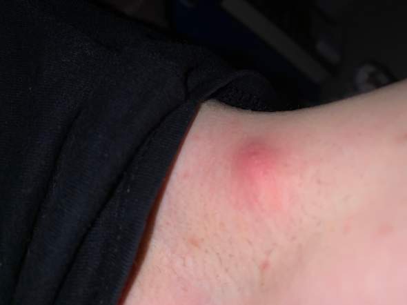 Pickelartiges Ding Unter Der Achsel Pickelartiges Ding Unter Der Achsel