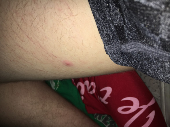 Pickel Am Oberschenkel Haut Dermatologie