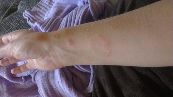 Mein Arm mit angeblichem Hefepilz - (Haut, Ansteckung, Pilze)