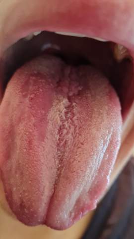 Pilzinfektion im Mund durch Asthmaspray (Achtung mit Foto)?