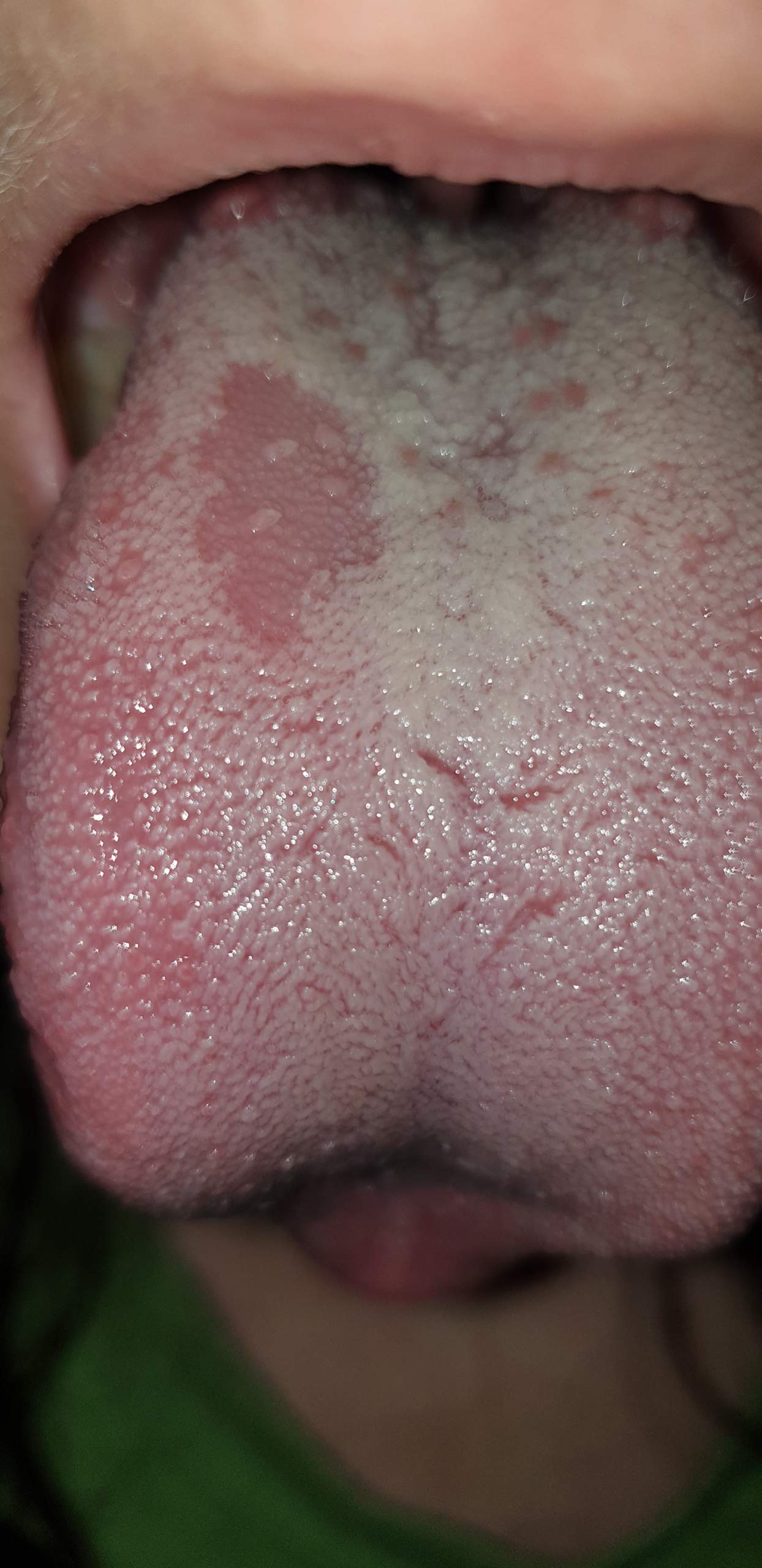 Pinker Fleck auf Zunge, welcher nicht von Belag betroffen ist ...