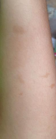 Plotzlich Braune Flecken Am Unterarm Haut Arm