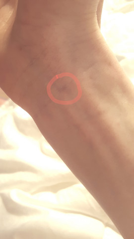 Pulsader am Handgelenk hat dumpf geschmerzt und nun ist ein kleiner