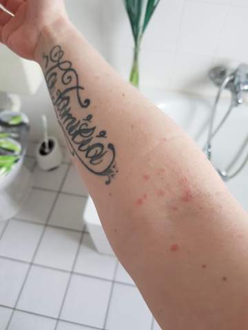 Punkte Am Korper Ausschlag Hautprobleme Punkte Am Korper Ausschlag Hautprobleme