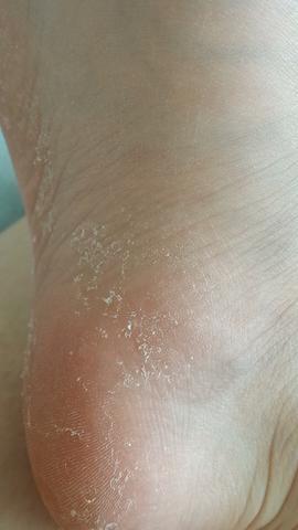 Was ist das für eine raue Haut an der Fußsohle?