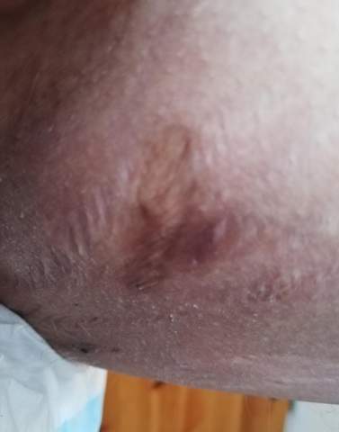 Reizung Der Haut Hautpflege Abszess Reizung Der Haut Hautpflege Abszess