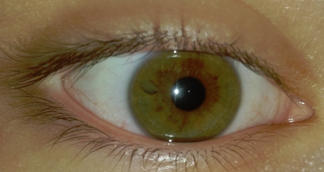 Riss im Auge? (Augen, Augenarzt, Kontaktlinsen)