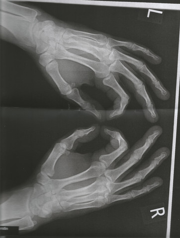 Hände - (Psoriasis-Arthritis, Röntgenbilder Hände)