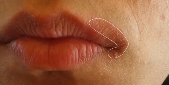 Rotung An Lippenrand Brennt Fuhlt Sich Sprode An Haut Mund Lippe Rotung An Lippenrand Brennt Fuhlt Sich Sprode An Haut Mund Lippe