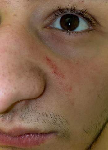 Rotung Neben Der Nase Hno Schnupfen