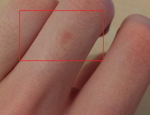 Rötung an der Hand - 3 Wochen alt - (Haut, Verletzung, Wunde)