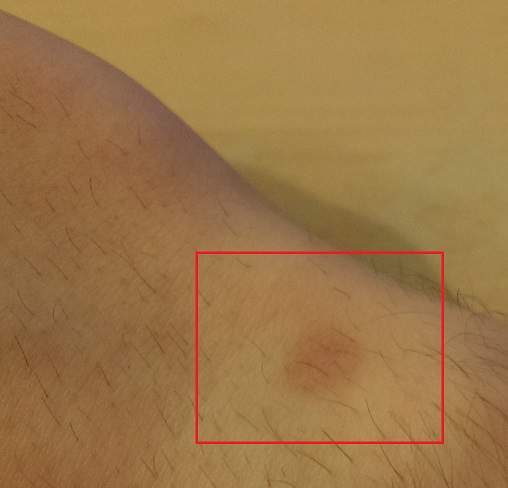 Rötungen/Rote Punkte von kleineren Wunden heilen/verschwinden seit