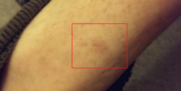 Rötung am Bein - Mindestens 5 Jahre alt - (Haut, Verletzung, Wunde)
