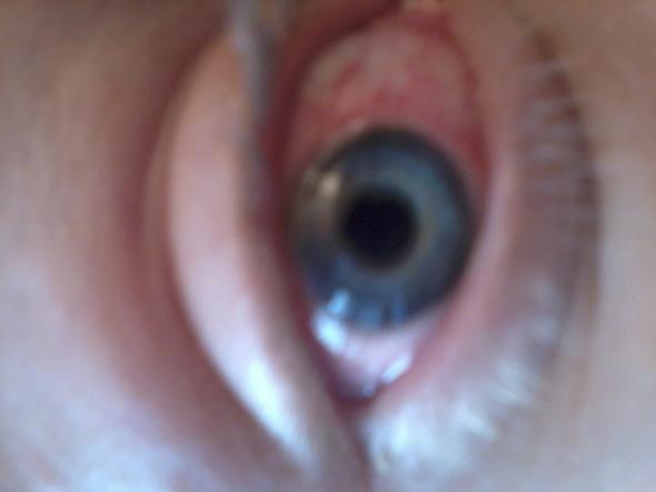 Rotes Auge - (Augen, Allergie, Juckreiz)