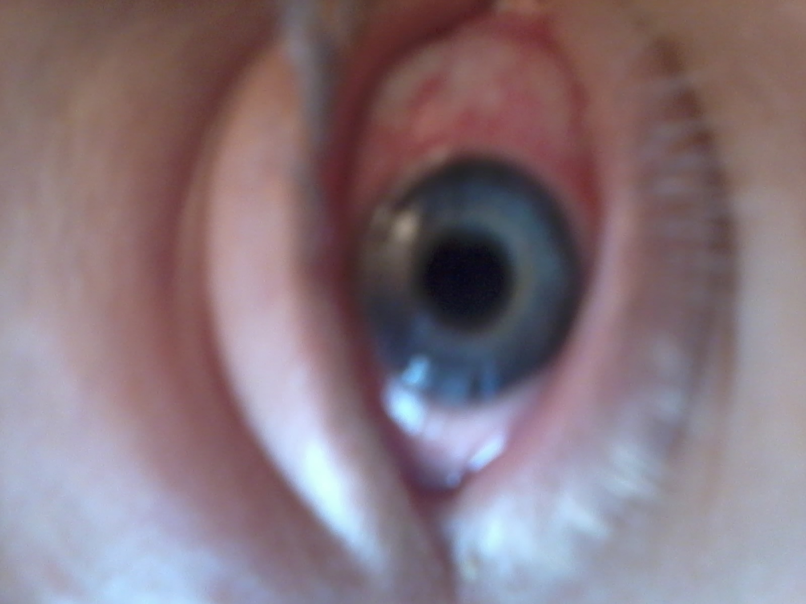 Rote Augen Hauptsachlich Anfang Und Ziemlich Am Ende Des Jahres Keine Drogen Allergie Juckreiz Rote Augen Hauptsachlich Anfang Und Ziemlich Am Ende Des Jahres Keine Drogen Allergie Juckreiz
