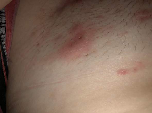 rote blasen zwischen oberschenkeln und