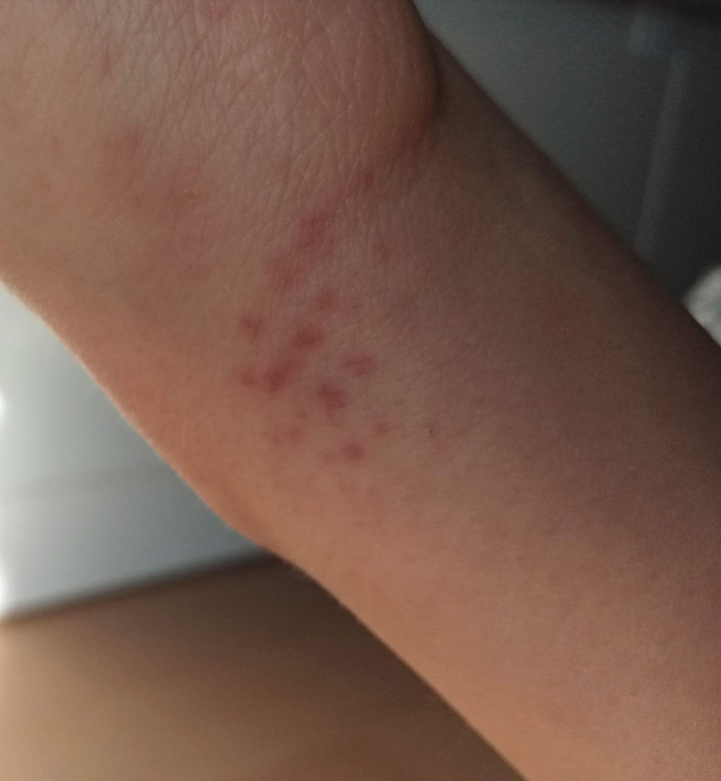 Rote Flecken am Handgelenk? (Haut,