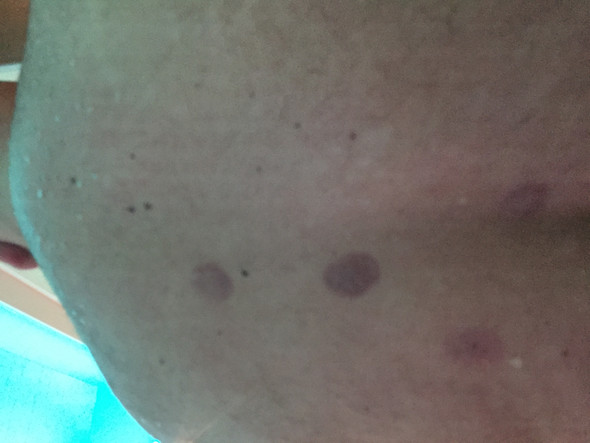 Flecken - (Haut, Dermatologie, Rötung)