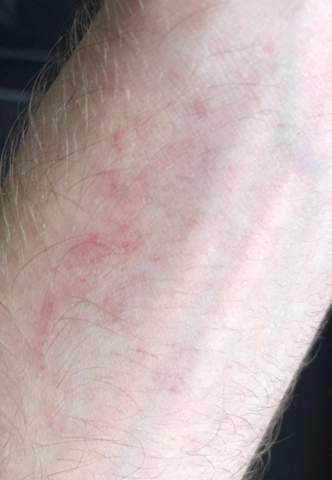 - (Haut, Dermatologie, Flecken)