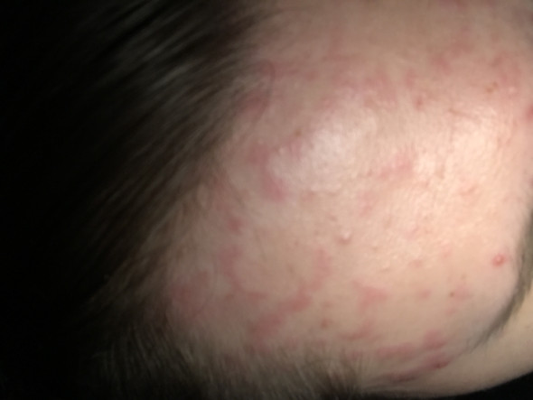 Rote Flecken Auf Stirn Haut Pickel Dermatologie