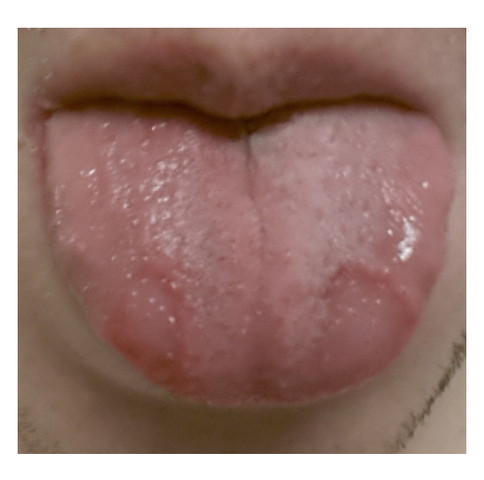 Rote Flecken auf Zunge?