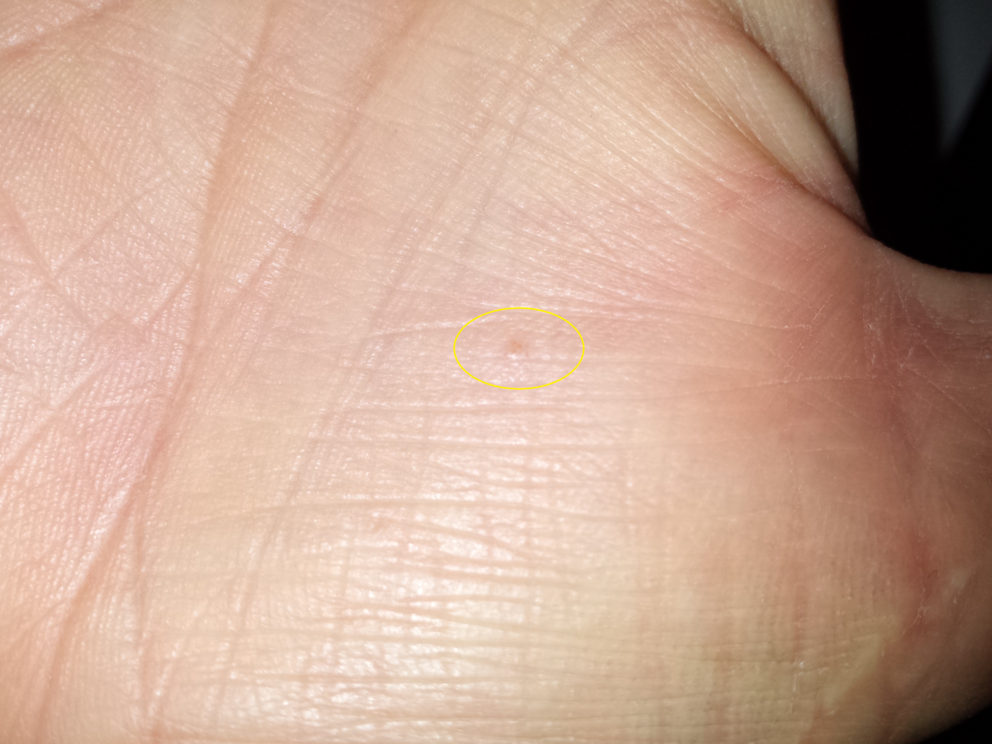 Die Laserbehandlung der Nagelzwang beim Kind