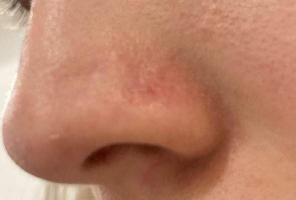 rote Linien bei Piercing?