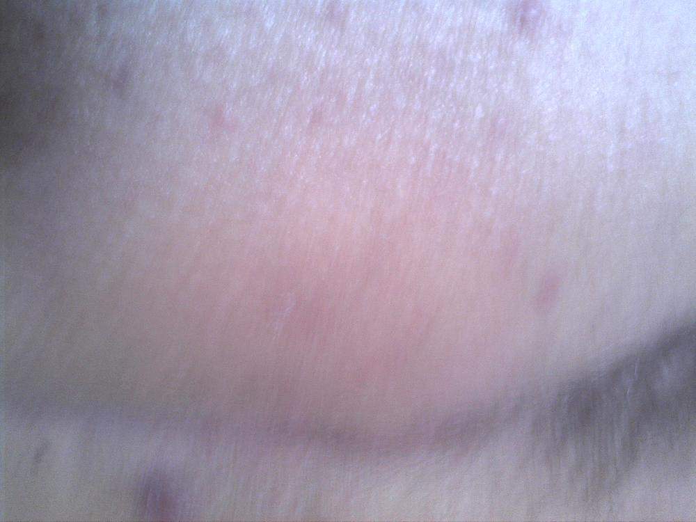 Rote Pickel am PO (Schmerzen, Haut, Hilfe)
