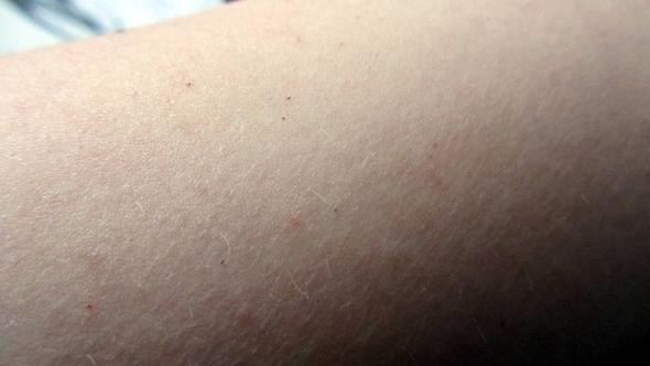 Rote Punktchen Auf Den Armen Blut Arm Rotung Rote Punktchen Auf Den Armen Blut Arm Rotung